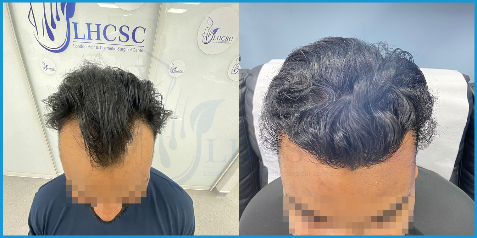 Frontal hairline restoration — before and after hair transplant at London Hair Transplant Clinic