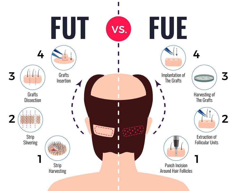 FUE hair transplant at London Hair Transplant Clinic