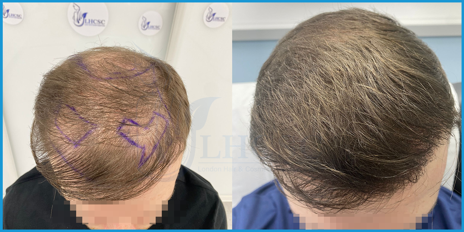 Diffuse thinning correction — before and after hair transplant at London Hair Transplant Clinic