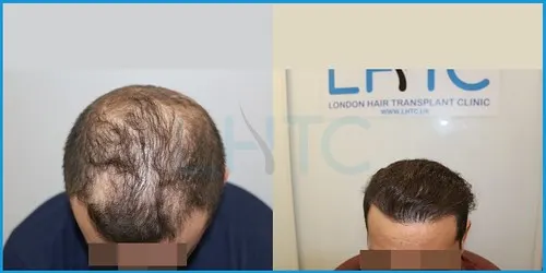 Before and after hair transplant case result 1 at London Hair Transplant Clinic
