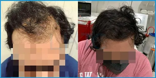 Before and after hair transplant case result 2 at London Hair Transplant Clinic