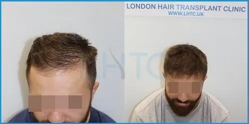 Before and after hair transplant case result 3 at London Hair Transplant Clinic