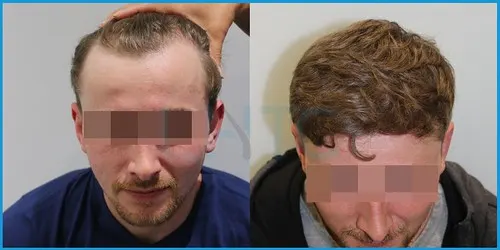 Before and after hair transplant case result 4 at London Hair Transplant Clinic