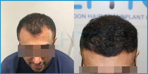 Before and after hair transplant case result 5 at London Hair Transplant Clinic