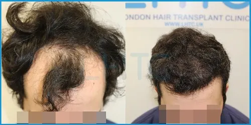 Before and after hair transplant case result 6 at London Hair Transplant Clinic