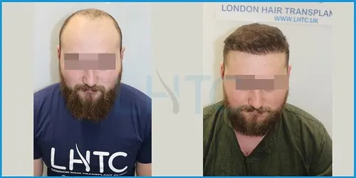 Before and after hair transplant case result 8 at London Hair Transplant Clinic