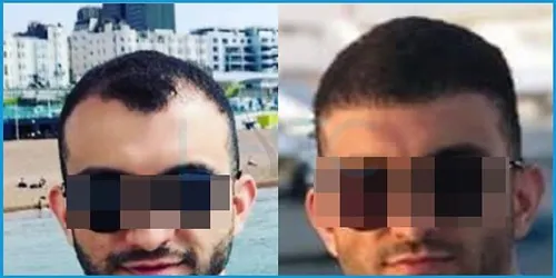Before and after hair transplant case result 9 at London Hair Transplant Clinic