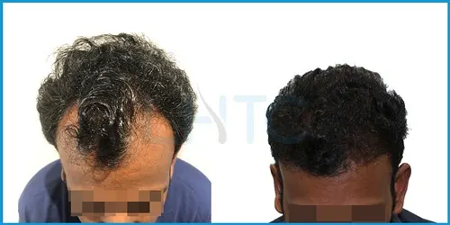 Before and after hair transplant case result 10 at London Hair Transplant Clinic