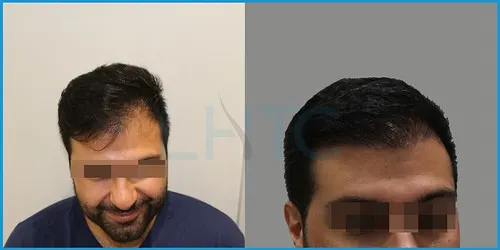 Before and after hair transplant case result 11 at London Hair Transplant Clinic
