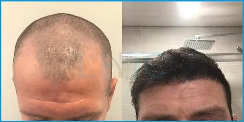 Before and after hair transplant case result 12 at London Hair Transplant Clinic