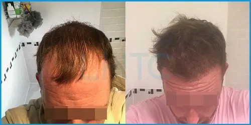 Before and after hair transplant case result 13 at London Hair Transplant Clinic