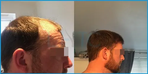 Before and after hair transplant case result 14 at London Hair Transplant Clinic