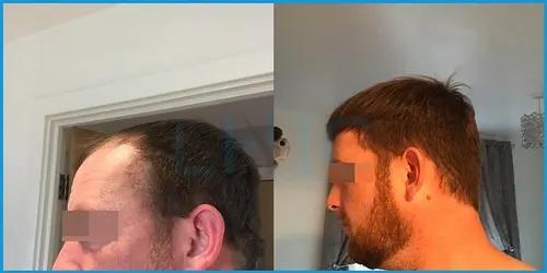Before and after hair transplant case result 15 at London Hair Transplant Clinic
