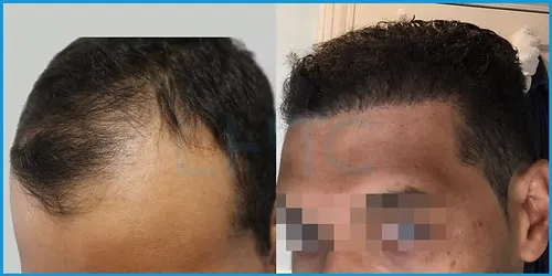 Before and after hair transplant case result 16 at London Hair Transplant Clinic