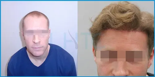 Before and after hair transplant case result 17 at London Hair Transplant Clinic