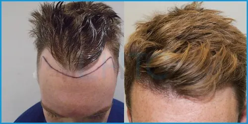 Before and after hair transplant case result 18 at London Hair Transplant Clinic