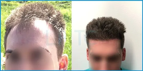 Before and after hair transplant case result 19 at London Hair Transplant Clinic