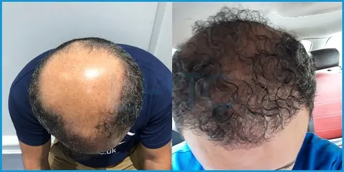 Before and after hair transplant case result 20 at London Hair Transplant Clinic