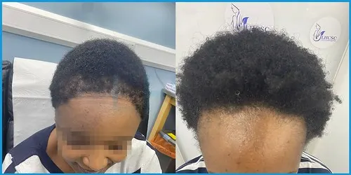 Before and after Afro-Caribbean hair transplant result 1 at London Hair Transplant Clinic