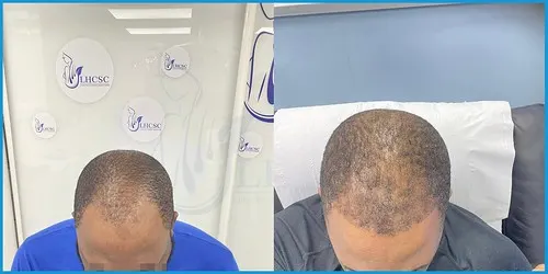Before and after Afro-Caribbean hair transplant result 3 at London Hair Transplant Clinic