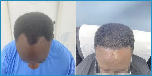Before and after Afro-Caribbean hair transplant result 4 at London Hair Transplant Clinic