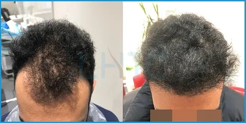 Before and after Afro-Caribbean hair transplant result 5 at London Hair Transplant Clinic
