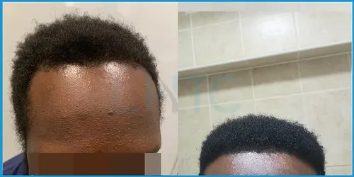 Before and after Afro-Caribbean hair transplant result 6 at London Hair Transplant Clinic
