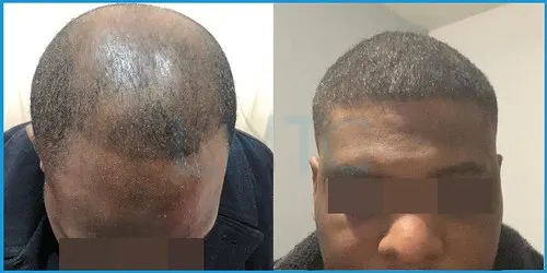 Before and after Afro-Caribbean hair transplant result 7 at London Hair Transplant Clinic