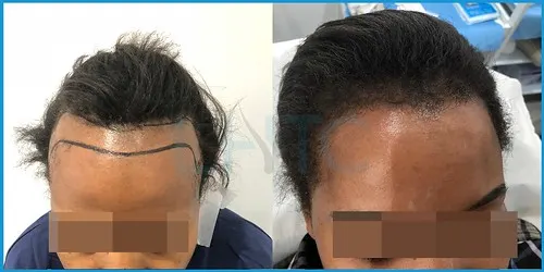 Before and after Afro-Caribbean hair transplant result 8 at London Hair Transplant Clinic