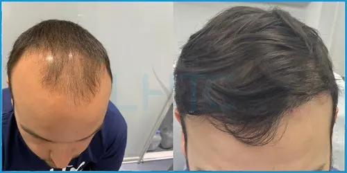Before and after extensive hair loss (Norwood VI–VII) hair transplant result 1 at London Hair Transplant Clinic