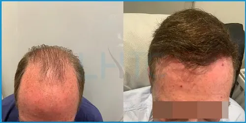 Before and after extensive hair loss (Norwood VI–VII) hair transplant result 2 at London Hair Transplant Clinic