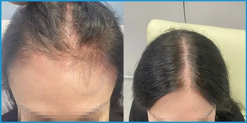 Before and after female hair transplant result 1 at London Hair Transplant Clinic
