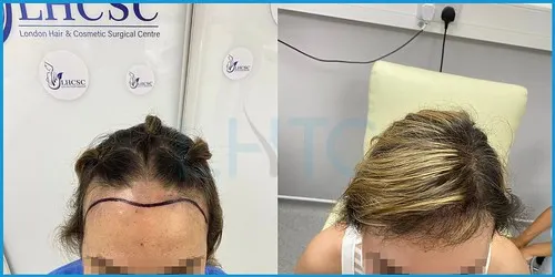 Before and after female hair transplant result 2 at London Hair Transplant Clinic