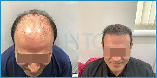 Before and after full hair restoration result 1 at London Hair Transplant Clinic