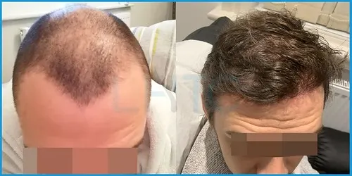 Before and after full hair restoration result 2 at London Hair Transplant Clinic