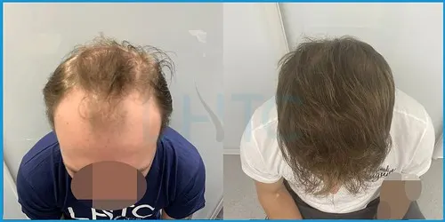 Before and after full hair restoration result 3 at London Hair Transplant Clinic
