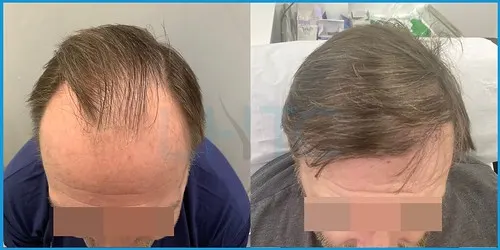 Before and after full hair restoration result 4 at London Hair Transplant Clinic