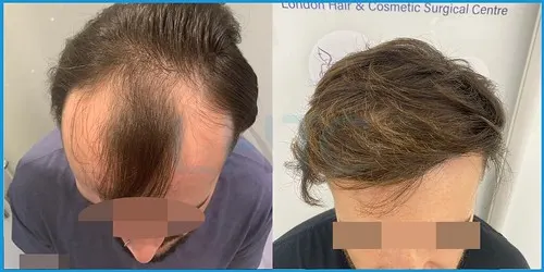 Before and after full hair restoration result 5 at London Hair Transplant Clinic