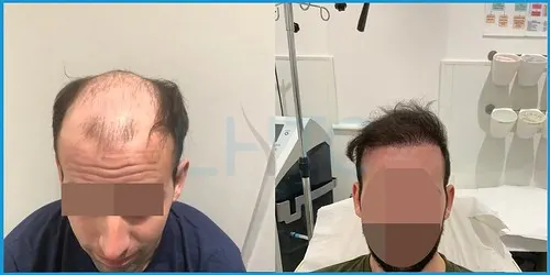 Before and after full hair restoration result 6 at London Hair Transplant Clinic
