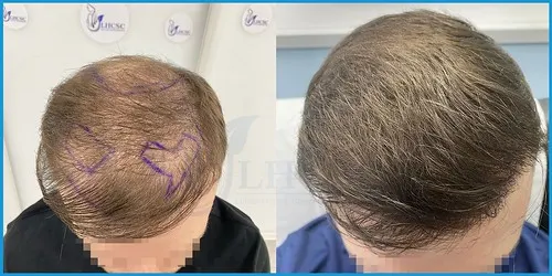 Before and after male FUE hair transplant result 1 at London Hair Transplant Clinic