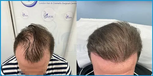 Before and after male FUE hair transplant result 2 at London Hair Transplant Clinic