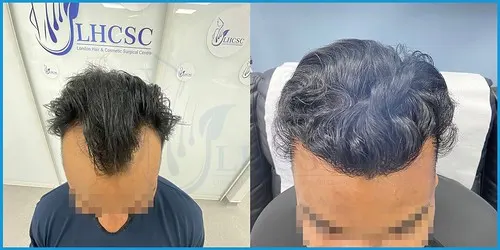 Before and after male FUE hair transplant result 3 at London Hair Transplant Clinic