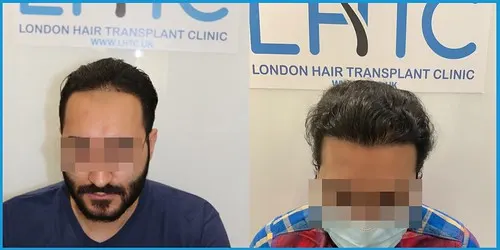 Before and after Norwood II–IV hair transplant result 1 at London Hair Transplant Clinic