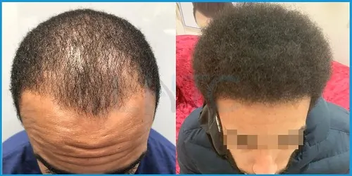 Before and after Norwood II–IV hair transplant result 2 at London Hair Transplant Clinic