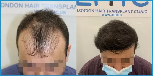Before and after Norwood II–IV hair transplant result 3 at London Hair Transplant Clinic