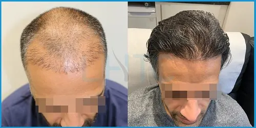 Before and after Norwood II–IV hair transplant result 4 at London Hair Transplant Clinic