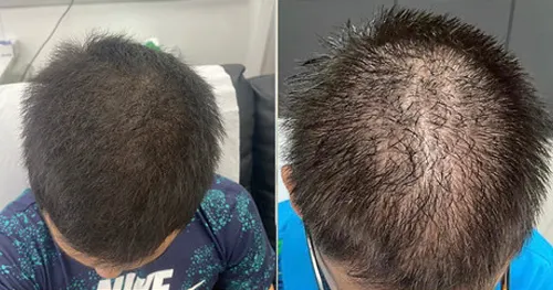 Before and after PRP hair loss treatment result 1 at London Hair Transplant Clinic