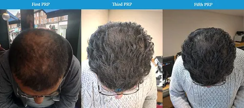 Before and after PRP hair loss treatment result 2 at London Hair Transplant Clinic