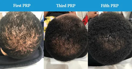 Before and after PRP hair loss treatment result 3 at London Hair Transplant Clinic