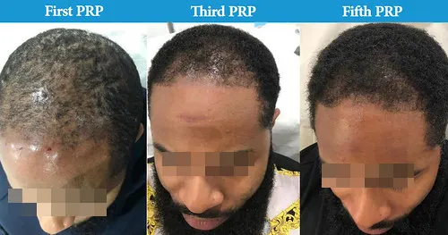 Before and after PRP hair loss treatment result 4 at London Hair Transplant Clinic